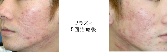 にきび治療に画期的な効果！「プラズマ」によるにきび・にきび跡 治療