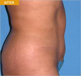 tummytuck_after.jpg