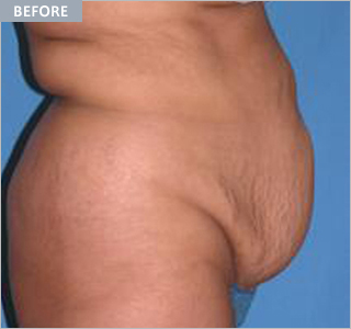 tummytuck_bedore.jpg