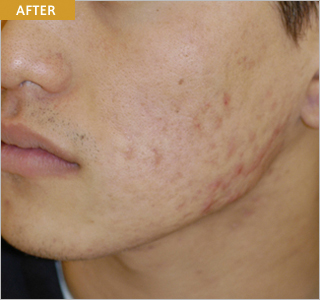 plasma_acne2_after.jpg