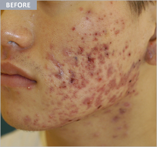 Plasma_acne2_before.jpg