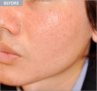 eco2_acne3_before.jpg