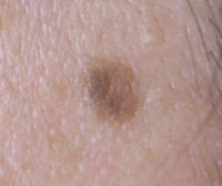 Seborrheic keratosis.jpg