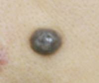 Pigmented nevi.jpg