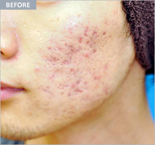 eco2_acne4_before.jpg