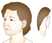 頬のリフト切開ライン.jpg