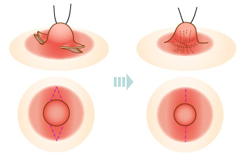 陥没乳頭.jpg