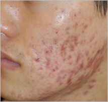 plasma_acne_progress3.jpg