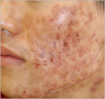 plasma_acne_progress2.jpg