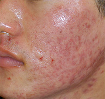 plasma_acne_progress1.jpg